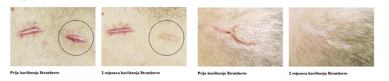Strataderm_korištenje_gela_OMC.jpg