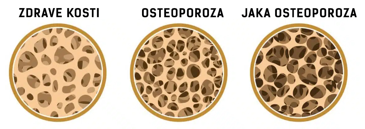 osteoporoza grafika