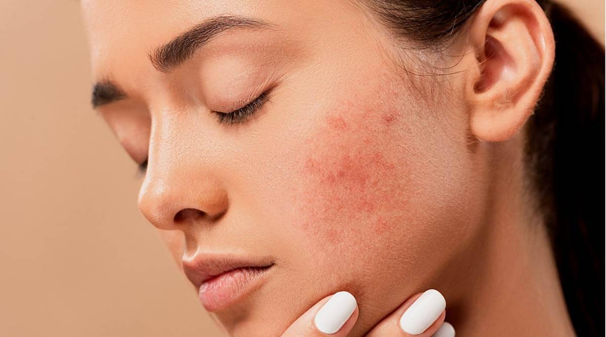 Tri najčešća neželjena stanja na koži - akne, dermatitis i rozacea