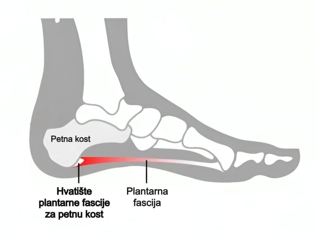 plantarna fascija slika članak OMC